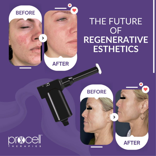 Microchannel Mini Glow